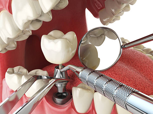 Best Emergency Treatment for Toothache in Annandale, NJ